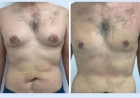 How the Best Gynecomastia Surgeons in dubai Address Concerns About Surgery