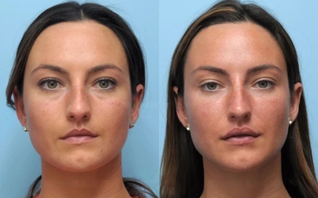 Get Natural Results with the Best Plastic Surgeon in Dubai for Thread Lift