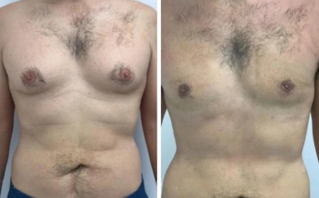 The Best Gynecomastia Surgeon in Dubai: What You Should Know About Their Expertise