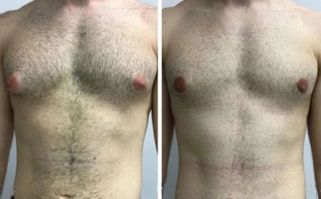 Consultation Tips with the Best Doctors in Dubai for Gynecomastia Patients