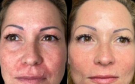 Refine Your Beauty Journey with Profhilo at the Best Aesthetic Clinics in dubai