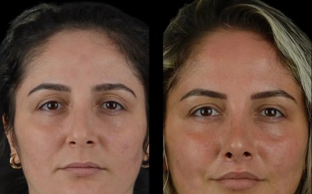 The Best Techniques for Achieving Beautiful Cheeks Fillers with the Best Plastic Surgeon in Dubai