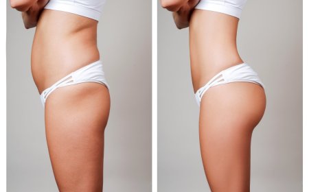 Why the Best Fat Transfer Surgeons in Dubai Are Your Key to Achieving Your Aesthetic Goals
