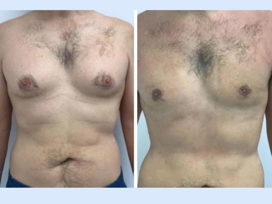 How the Best Gynecomastia Surgeons in dubai Address Concerns About Surgery