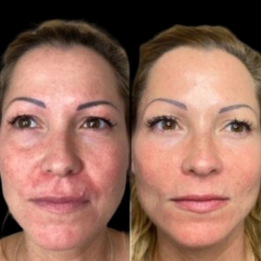 Refine Your Beauty Journey with Profhilo at the Best Aesthetic Clinics in dubai