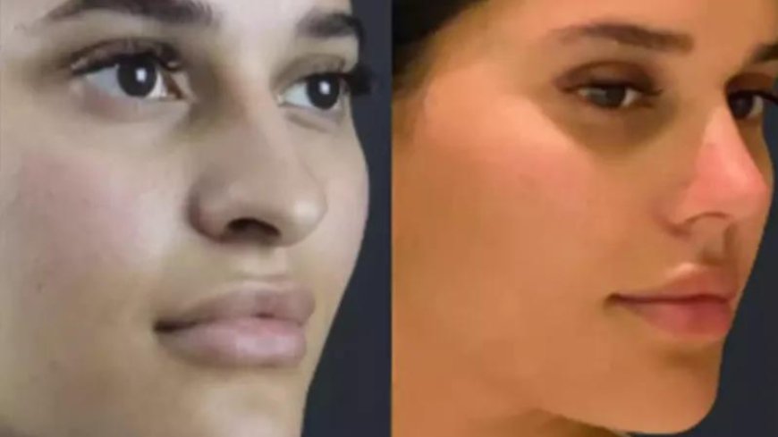 Rhinoplasty in Dubai: What You Need to Know About Scars