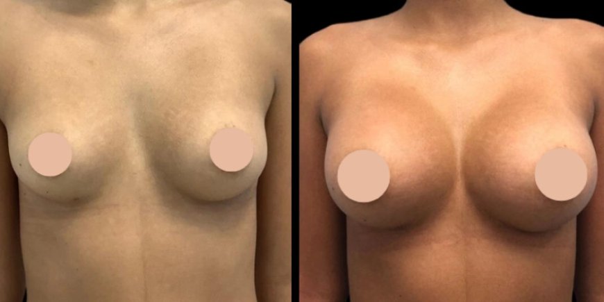 Your Journey Starts Here: Breast Augmentation Surgery in Dubai