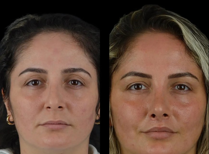 The Best Techniques for Achieving Beautiful Cheeks Fillers with the Best Plastic Surgeon in Dubai
