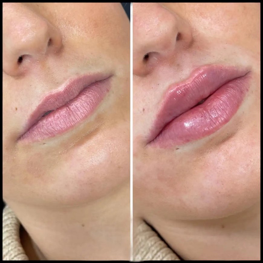 Russian Lip Fillers: The Best Plastic Surgeon in Dubai Difference