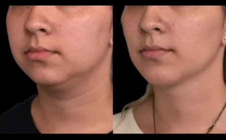 Best Doctors in Dubai Use 2025 Tech in Double Chin Diagnosis