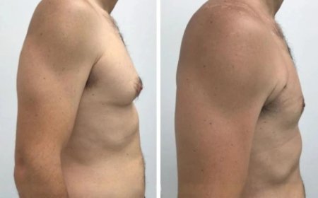 How to Prepare for Your Gynecomastia in Dubai Consultation: A Step-by-Step Guide