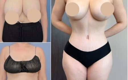 Tummy Tuck Surgery: Finding the Best Tummy Tuck Surgeon in Dubai for Your Aesthetic Goals