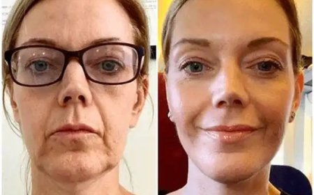 Command Glow at the Best Aesthetic Clinics in dubai with Profhilo