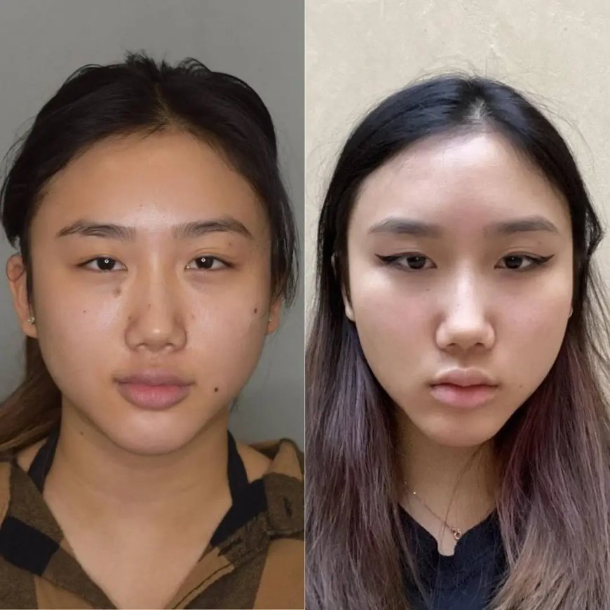 How to Speed Up Healing After Buccal Fat Removal: Tips from the Best Doctors in Dubai