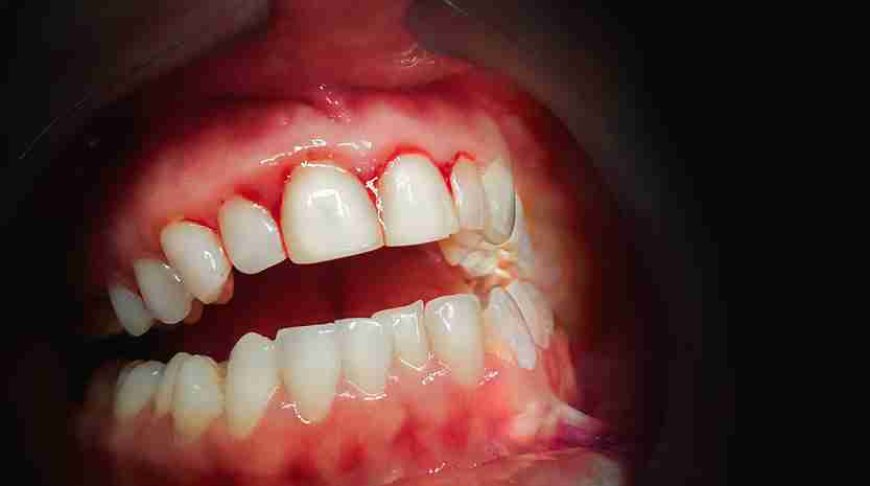 The Role of a Periodontist in Treating Bleeding Gums