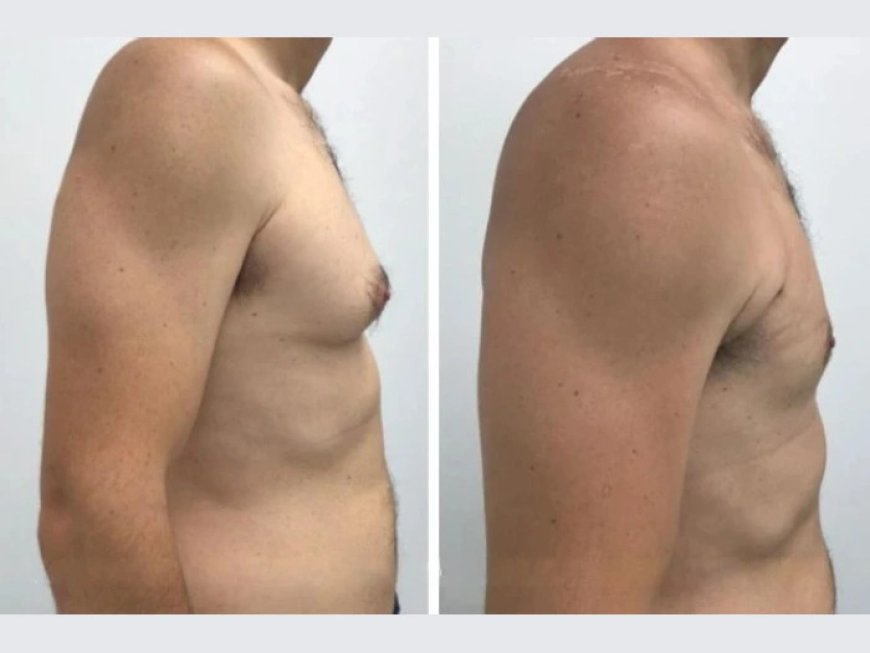 How to Prepare for Your Gynecomastia in Dubai Consultation: A Step-by-Step Guide