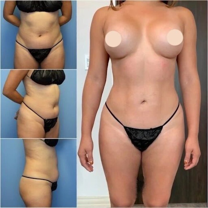 Find Your Perfect Shape with the Best Body Contouring Surgeon in Dubai