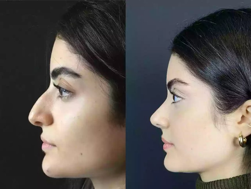 Trusted by Celebrities: The Best Rhinoplasty Surgeons in Dubai