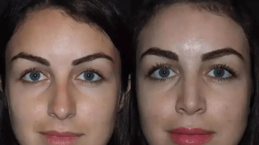 Rhinoplasty in Dubai: Combine Beauty with Function